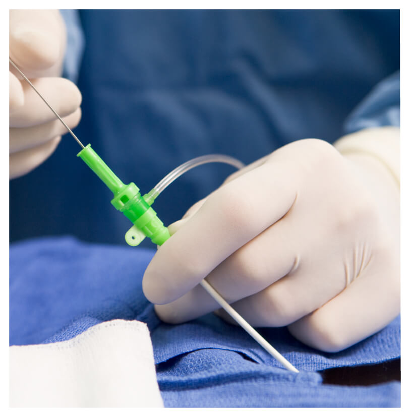 doctor performing an embolization 
