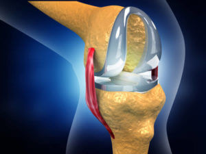 Human knee replacement implant. 3d illustration